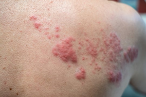 Chiropractic Can Help With Shingles